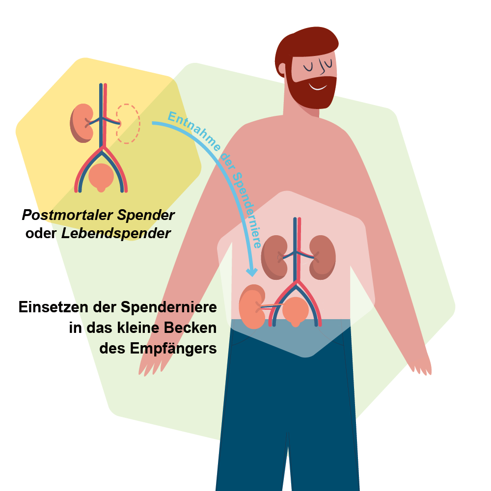 Transplant-Wissen > Vor der Transplantation > Organtransplantation, Nierentransplantation, Lebertransplantation, Durchführung Nierentransplantation, Durchführung Lebertransplantation, Lebendspende, postmortale Spende > Durchlauf einer Nierentransplantation