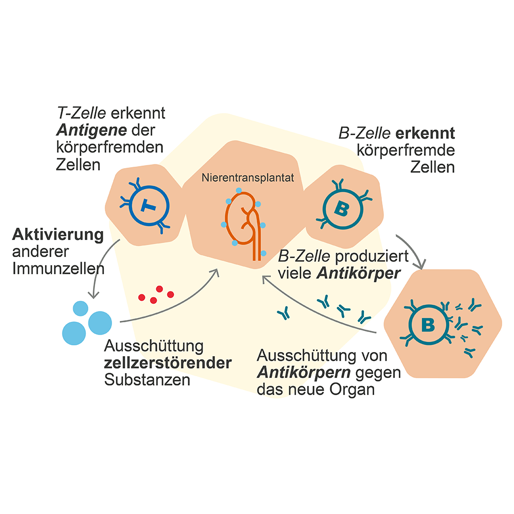 Transplant-Wissen > Medical > Abstoßung Spendeorgan